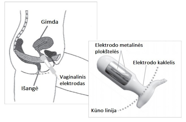 Iegurņa pamatnes stimulācijas ierīce NeuroTrac CONTINENCE